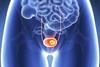 bladder-cancer-image