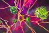 Neurons,In,Alzheimer's,Disease.,3d,Illustration,Showing,Amyloid,Plaques,In