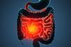 bowel-cancer