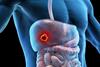 3d,Rendered,Medical,Illustration,Of,Male,Anatomy,-,Liver,Cancer.