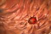 Peptic,Ulcer,,3d,Illustration,Showing,Closeup,View,Of,An,Ulcer