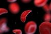 3d,Rendered,Medical,Illustration,Of,A,Sickle,Cell
