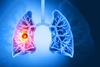 3d,Rendered,,Medically,Accurate,Illustration,Of,Lung,Cancer.,Showing,Presence
