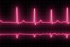 Electrocardiogram,With,Cardiac,Arrhythmia.,Neon,Atrial,Fibrillation,Has,Been,Recorded