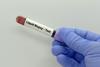 Doctor,Holds,Blood,Sample,For,Liquid,Biopsy,Test,To,Detect