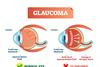 Glaucoma,Illness,Vector,Illustration.,Cross,Section,Close-up,Comparement,With,Normal