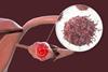 Ovarian,Cancer,,3d,Illustration,Showing,Malignant,Tumor,In,The,Left