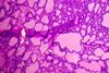 Synovial,Sarcoma,Histology,Image,Analyzed,By,Light,Microscope,At,Histopathology