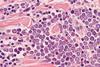 Microscopic,Image,(photomicrograph),Of,A,Merkel,Cell,Carcinoma,,A,Highly