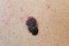 Melanoma,-,A,Malignant,Tumor,Of,Human,Skin