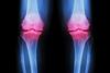 Osteoarthritis,Knee,(,Oa,Knee,).,Film,X-ray,Both,Knee