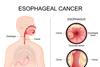 Esophageal,Cancer.,Transverse,Section,And,Coronal,Section,Of,Esophagus.,Adenocarcinoma.