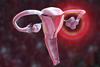 Polycystic,Ovary,Syndrome,,3d,Illustration,Showing,Healthy,Ovary,(right),And