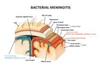 bacterial-meningitis-infection-meninges-brain-250nw-1045722319