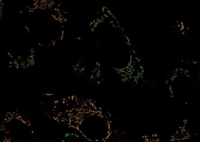MYC-Driven Breast Cancers Reveal New Metabolic Vulnerabilities for Targeted Therapy - News Directory 3