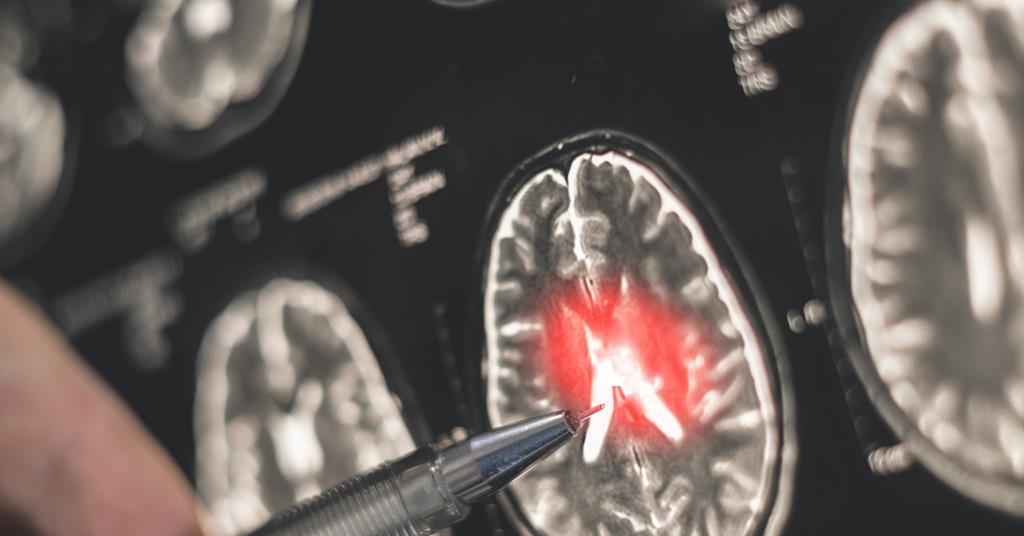 New Drug Combination May Improve Alzheimer’s Treatment