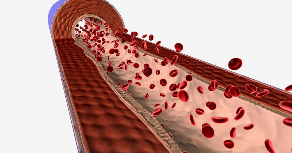 BMP3 Protein Identified as New Therapeutic Target for Pulmonary Arterial Hypertension