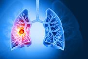 3d,Rendered,,Medically,Accurate,Illustration,Of,Lung,Cancer.,Showing,Presence