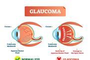 Glaucoma,Illness,Vector,Illustration.,Cross,Section,Close-up,Comparement,With,Normal
