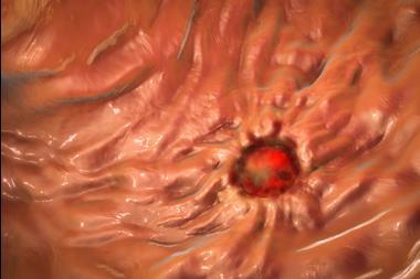 Peptic,Ulcer,,3d,Illustration,Showing,Closeup,View,Of,An,Ulcer