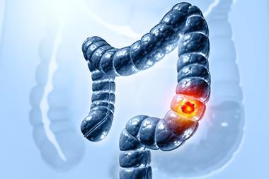 Colon,Cancer.,Cancer,Attacking,Cell.,Colon,Disease,Concept.,3d,Illustration