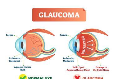 Glaucoma,Illness,Vector,Illustration.,Cross,Section,Close-up,Comparement,With,Normal