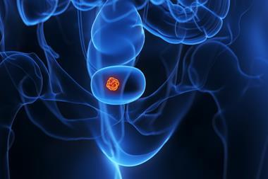 3d,Rendered,Medical,Illustration,Of,A,Bladder,Tumor