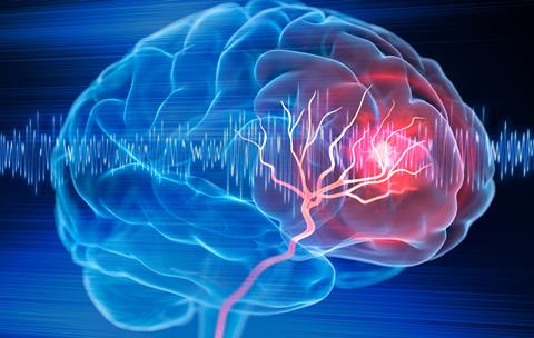X-,Ray,Illustration,Of,Brain,Stroke,-,3d,Illustration