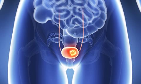 bladder-cancer-image