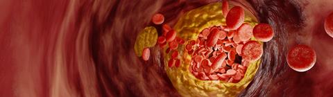 Hyperlipidemia,Or,Arteriosclerosis.,Blocked,Artery,Concept,And,Human,Blood,Vessel