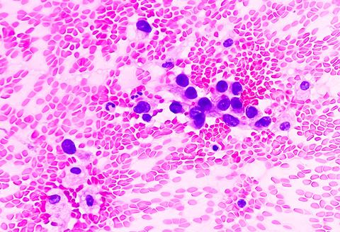 Lungs,Adenocarcinoma.,Malignant,Cell.,Smear,Show,Cellular,Material,Of,Atypical