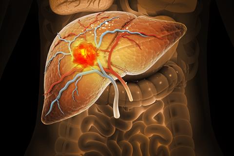 Liver,Cancer,,Hepatocellular,Carcinoma,(hcc),,Conditions,,Causes,And,Treatment.,3d