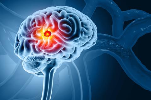 Brain,Tumor,Or,Barin,Cancer.,3d,Illustration