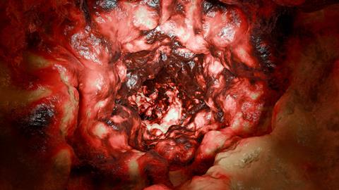 Colorectal,Cancer,,Malignant,Tumor,In,Intestine,,Endoscope,Inside,Colonoscopy,,Gut