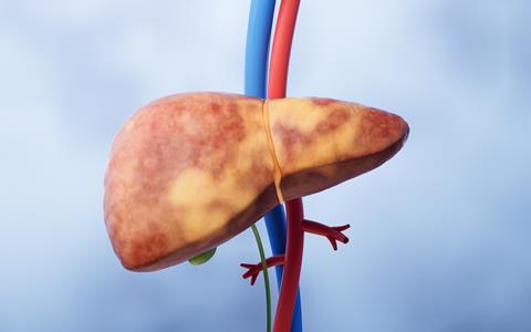 Liver,Organ,With,Fatty,Liver,State,,3d,Rendering.,3d,Illustration.