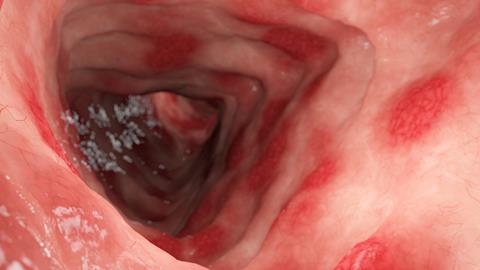 3d,Rendered,Illustration,Of,Colitis,Ulcerosa