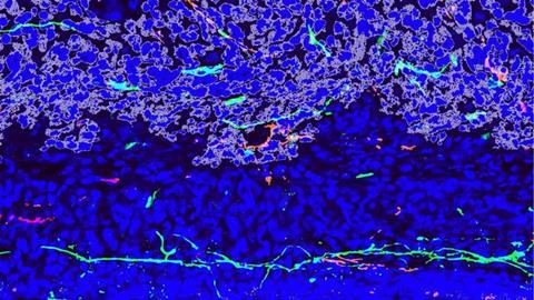 Low-Res_Murine Osteosarcoma Invading Normal Bone