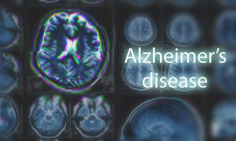 Alzheimer's-disease-image
