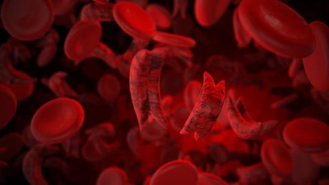 Sickle,Cell,Disease,Medical,Concept,3d,Illustration