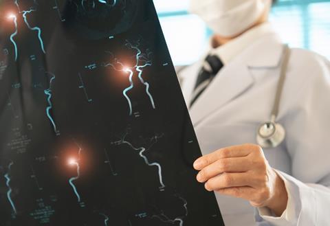 Doctor,Radiology,Looking,Stroke,Brain,Angiography,X-ray,Image,For,Diagnose