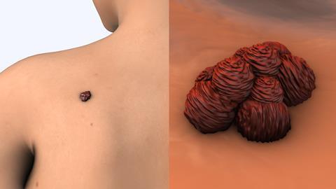 Metastatic,Melanoma,Cells,Medical,Animation,3d,Illustration