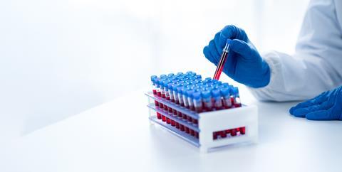 Doctor,Hand,Taking,A,Blood,Sample,Tube,From,A,Rack