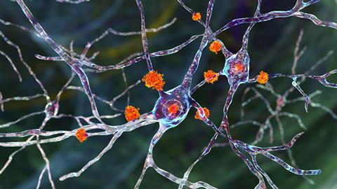 Neuronal,Inclusions,In,Huntington's,Disease,,3d,Illustration.,Inclusions,Are,Composed