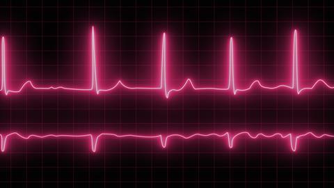 Electrocardiogram,With,Cardiac,Arrhythmia.,Neon,Atrial,Fibrillation,Has,Been,Recorded