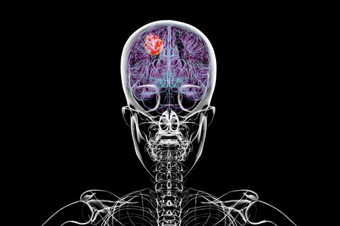 3d,Illustration,Of,A,Brain,Tumor,,Highlighting,Its,Location,And