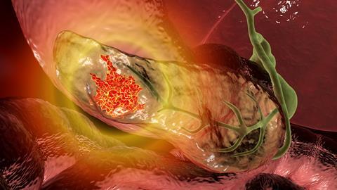 Pancreatic,Cancer,,Malignant,Tumor,Of,Pancreas,,3d,Illustration