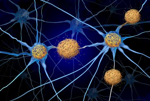 Tau,Tangles,And,Amyloid,Beta,Concept,As,Abnormal,Clusters,Of