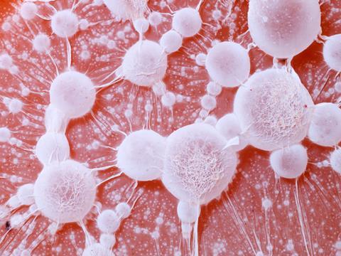 Cancer,Tumour.tumors,With,Metastases