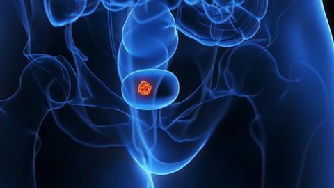 3d,Rendered,Medical,Illustration,Of,A,Bladder,Tumor