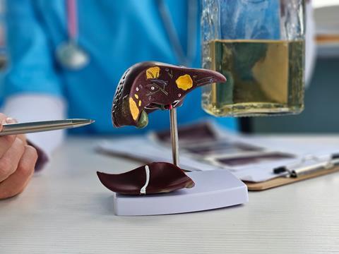 Alcoholic,Liver,Damage,And,Liver,Cirrhosis,Concept,With,Liver,And